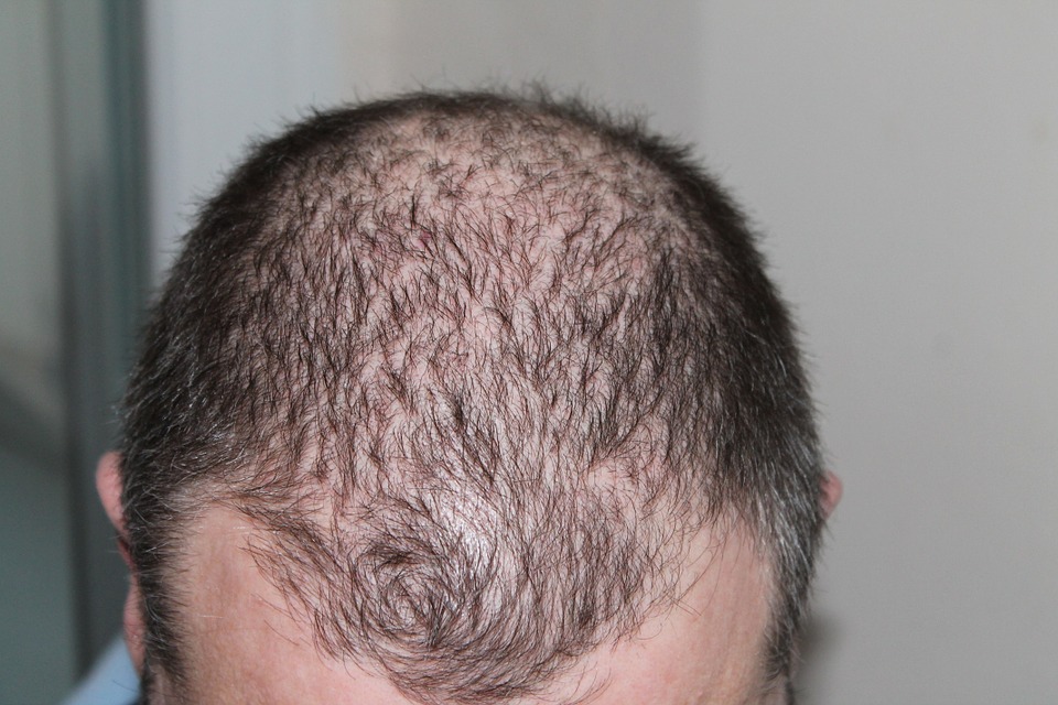 fue hair transplant
