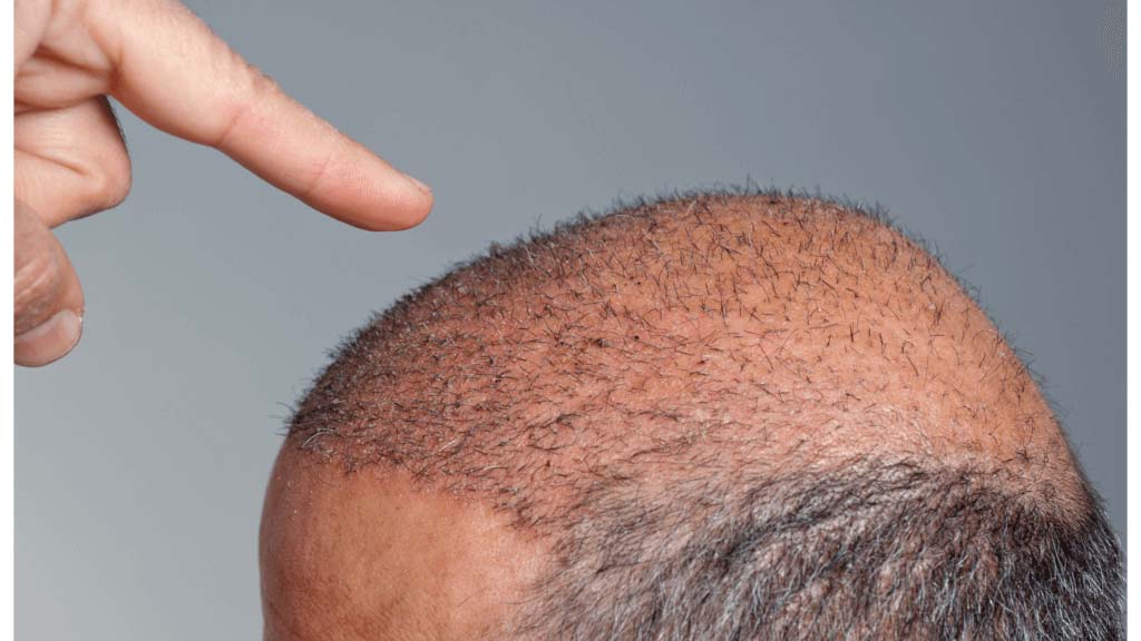 Changing Hair Restoration: New Developments in Hair Transplant Methodologies