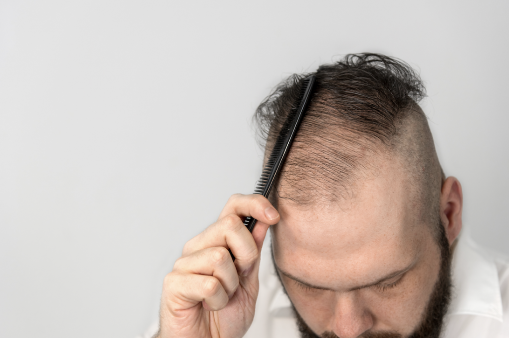 Oral vs. topical finasteride: The Greatest Fight for Hair Growth